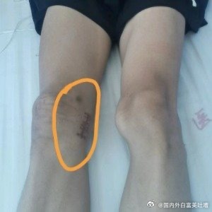 体育生被误切右膝，母亲的坚持与正义呼声