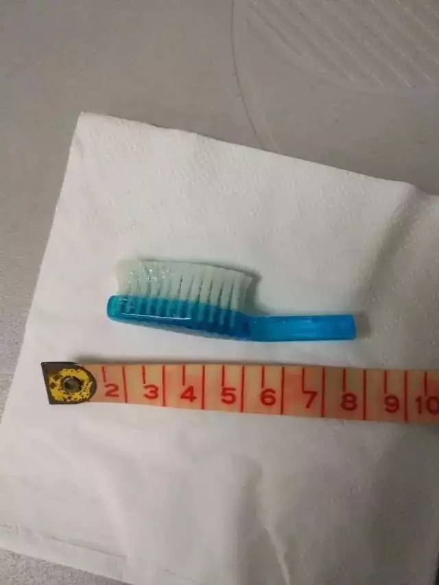 大爷体内惊现藏身52年的牙刷，误以为能溶解消失