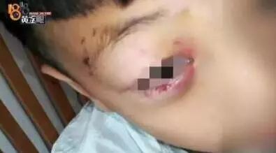 男子被狗咬伤后未就医，三个月后悲剧离世