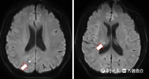 扛不住的感冒，男子突发脑梗死警醒我们重视身体信号