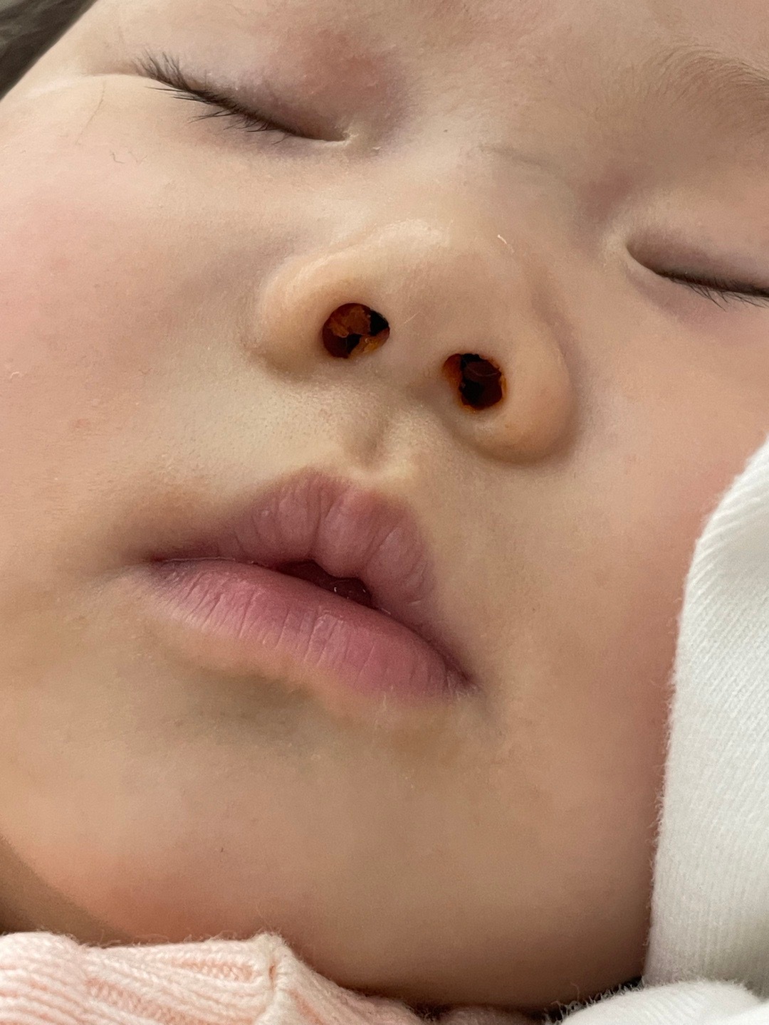 一、揭秘事件，1岁娃鼻孔长出豆芽，怎么办？