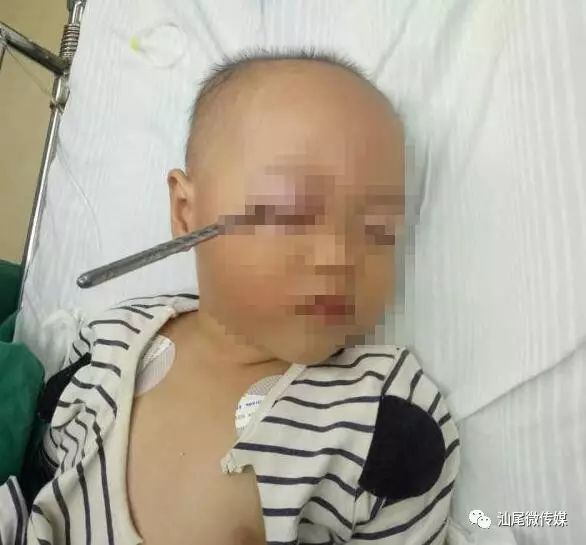 小孩被筷子戳穿事件，深度分析与反思