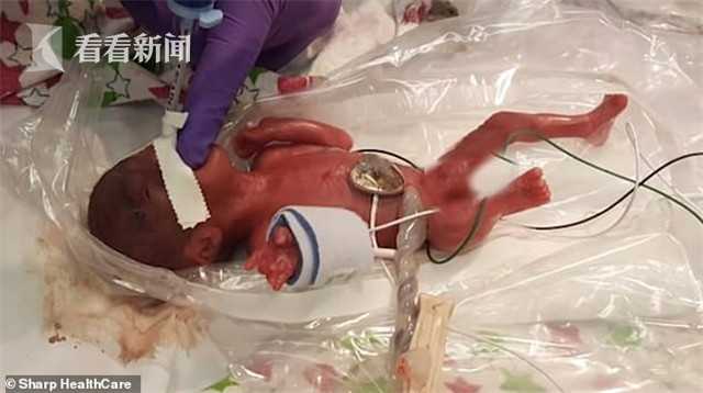 早产儿死而复生事件，奇迹背后的故事