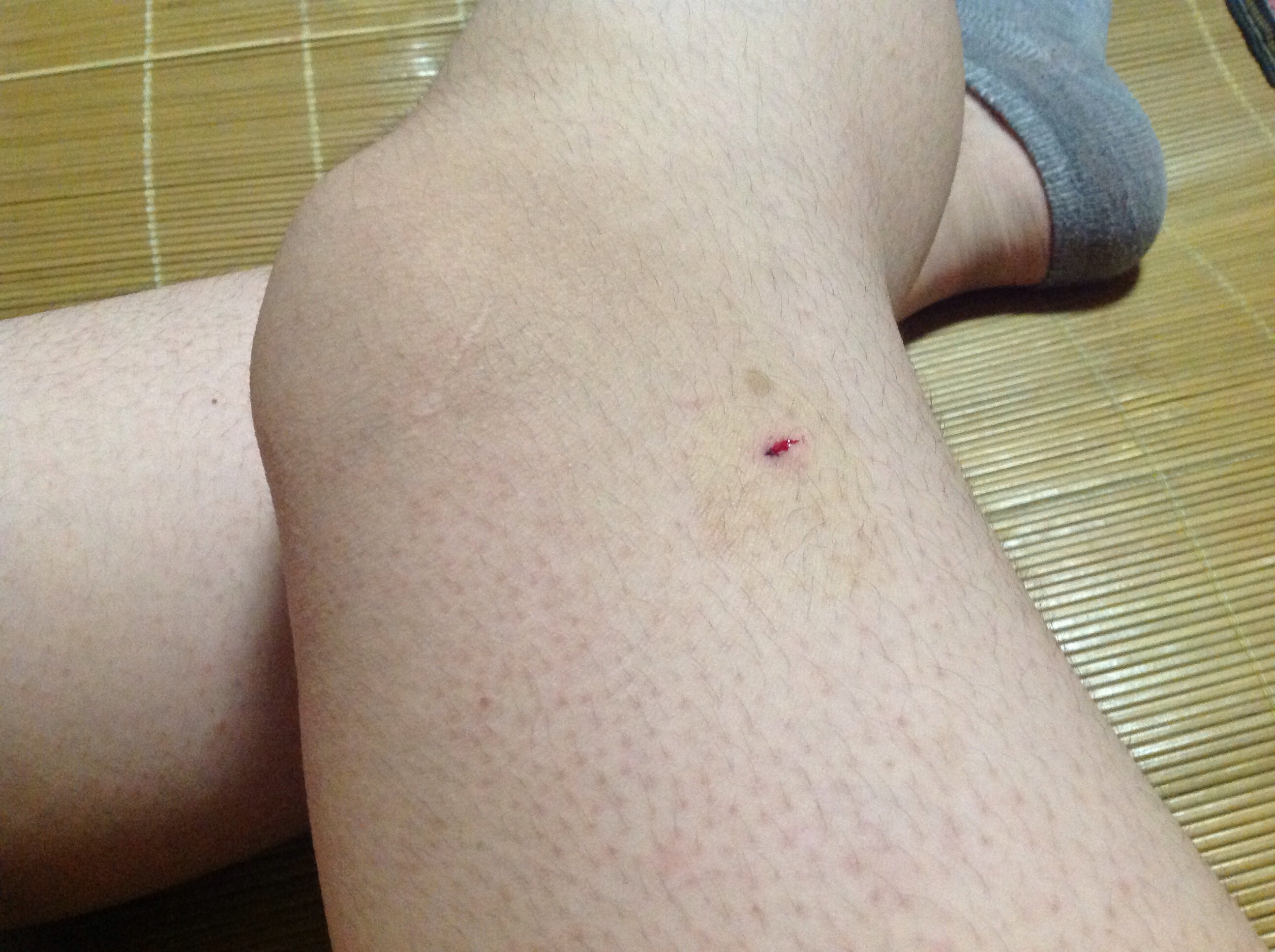 烧烤签扎破腿，后果解析与应对建议