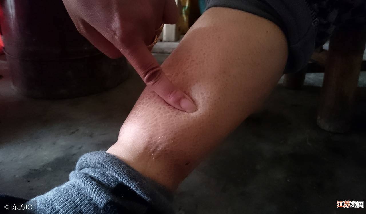 腿被烧烤签扎伤周围肿胀，正确处理与护理指南