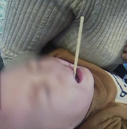 烧烤狂欢后的危机处理指南，烧烤签子扎到喉咙里怎么办？