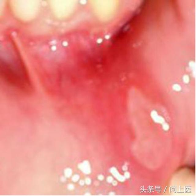 口腔溃疡背后的秘密，HPV病毒感染的可能性探讨