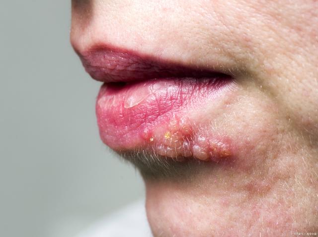 口腔溃疡会感染HPV病毒吗？解析口腔健康与HPV病毒的关系