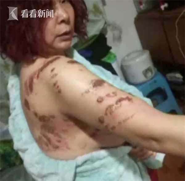 拔火罐被烧伤的男艺人，事件解析与反思