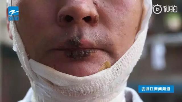 拔火罐被烧伤的男艺人，事件解析与反思