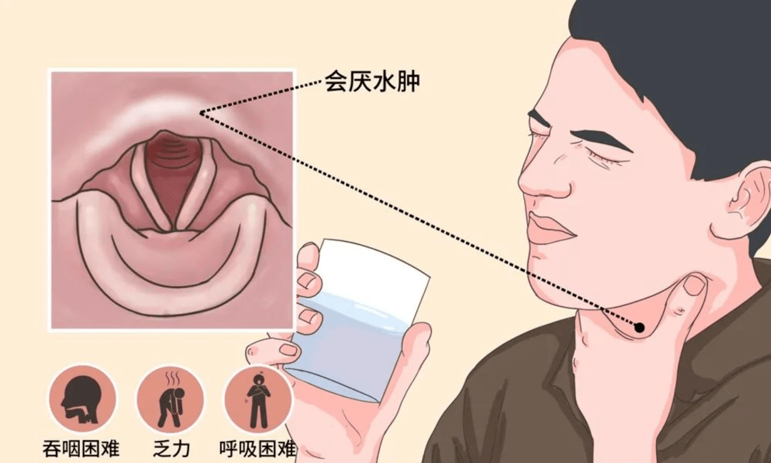 喉咙痛患会厌炎去世，警惕咽喉健康的警钟