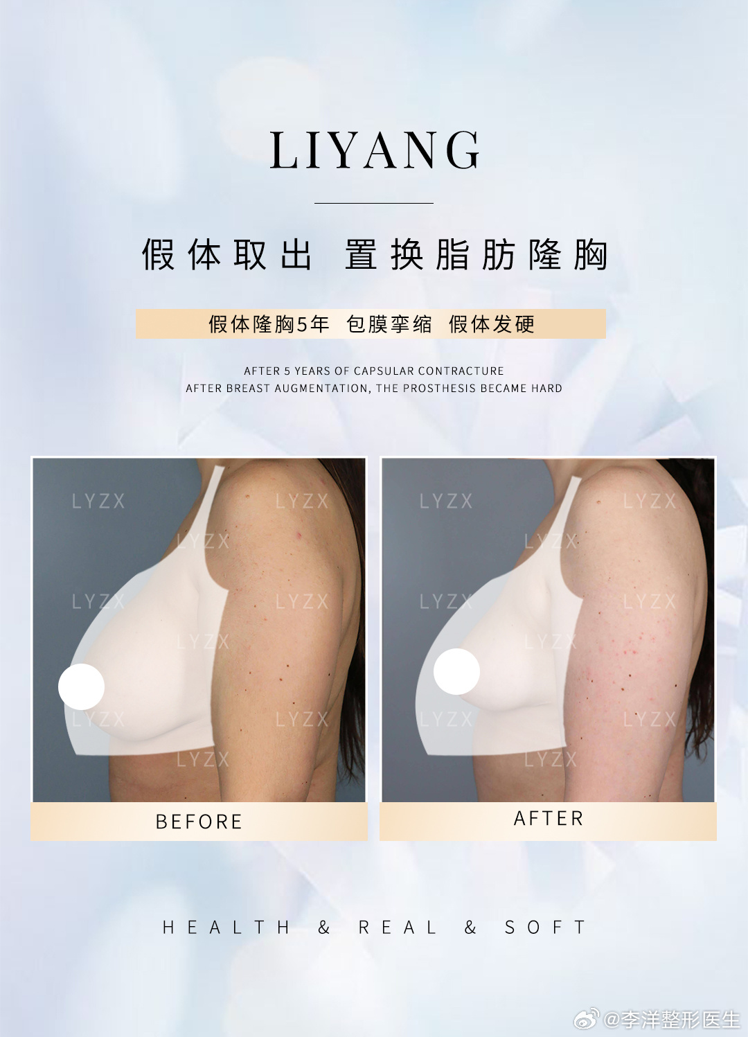 隆胸后的华丽转变，四个胸的时尚新纪元