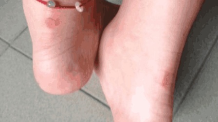 女生穿鞋磨脚后跟怎么处理