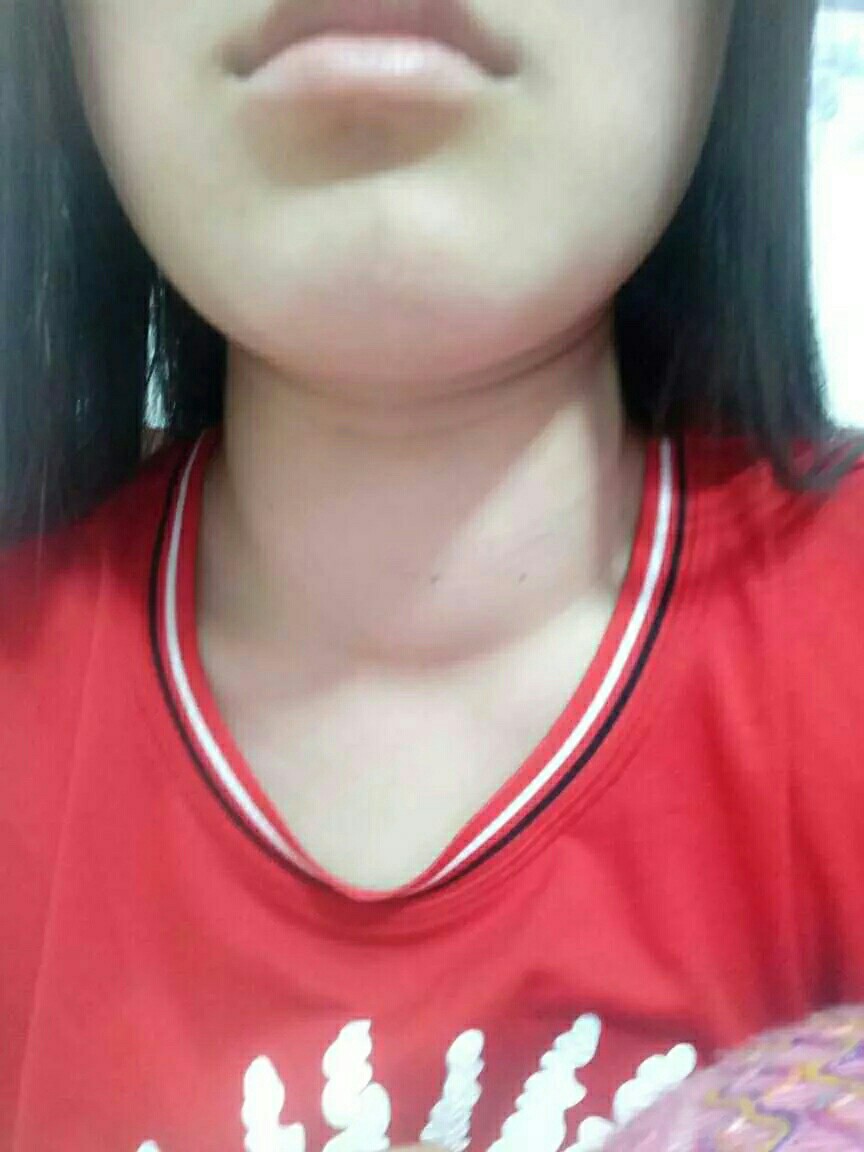 我甲亢了，经历与启示