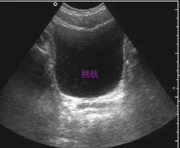 男子高速憋尿12小时膀胱炸裂事件深度解析