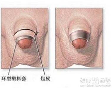 男性生殖做手术的原因分析