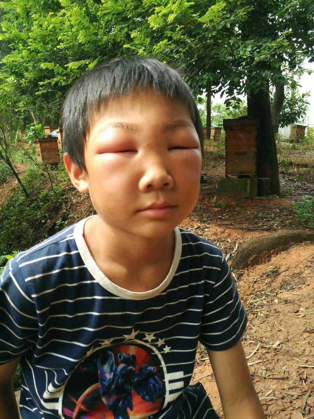 被蜜蜂蜇的小孩，一次意外的成长经历