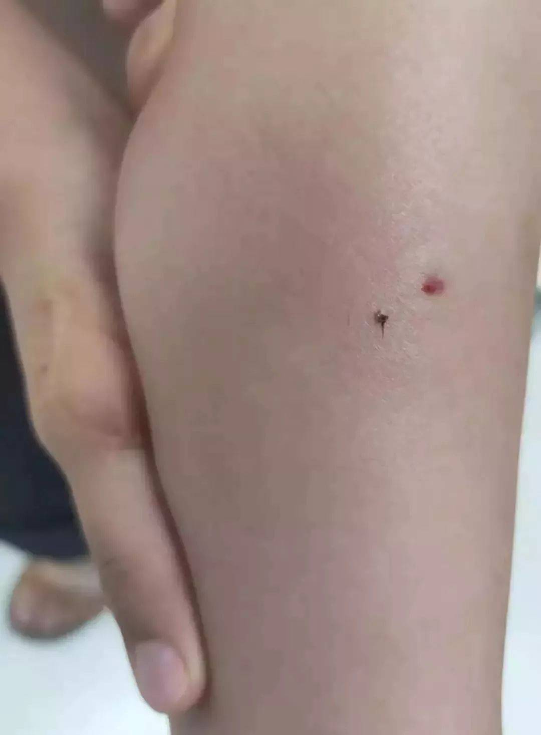 小孩被蜜蜂蛰了有毒吗？全面解析与应对指南