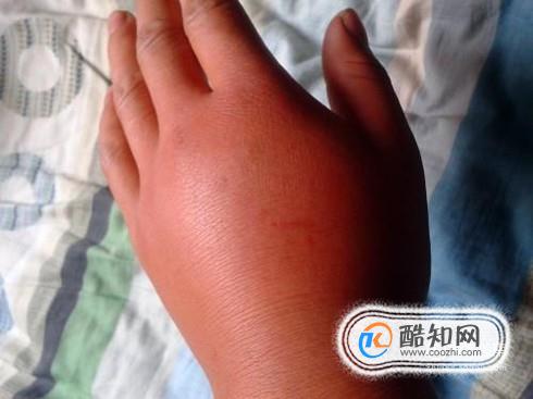 小孩被蜜蜂蛰了有毒吗？全面解析与应对指南