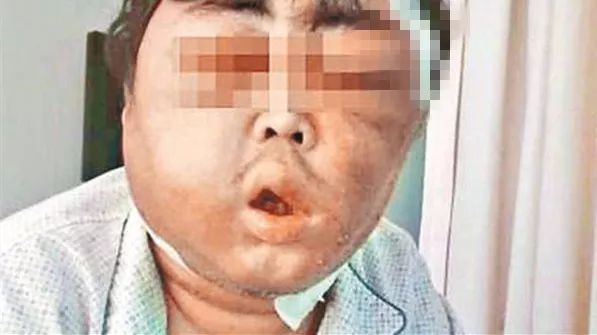 廉价纸擦脸肿成猪头，一场哭笑不得的荒诞经历