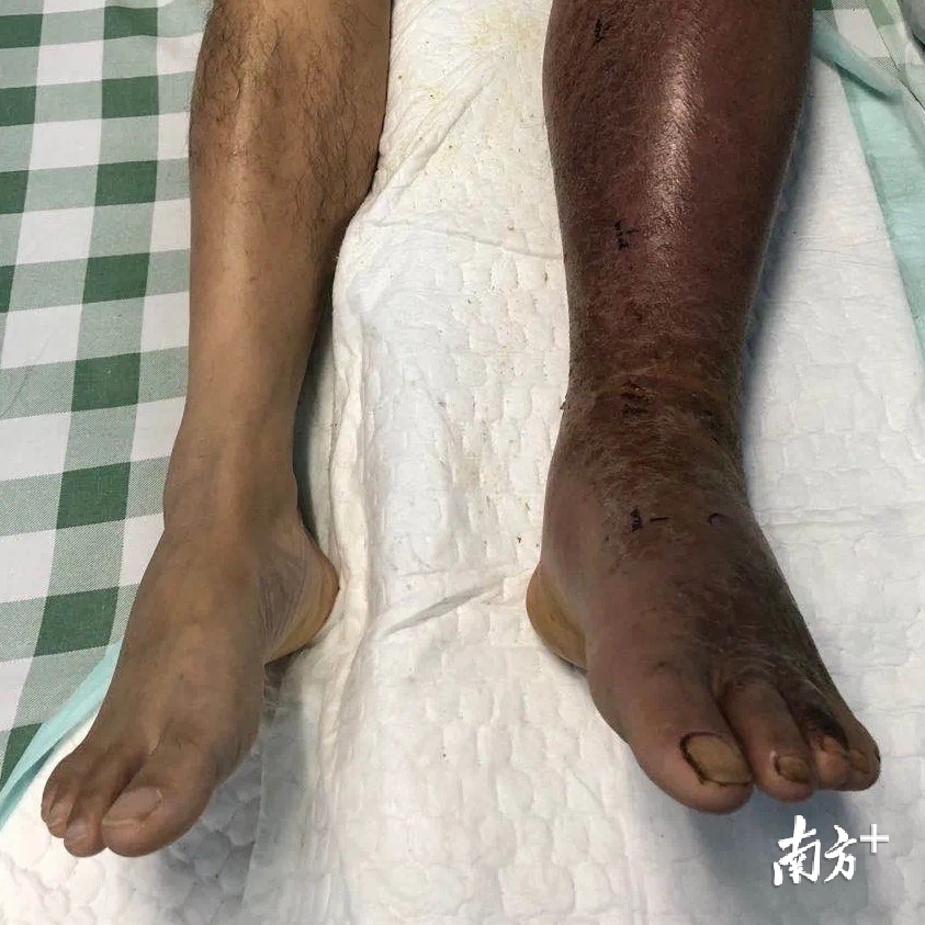 被蛇咬饮药酒险断臂，一场命运的博弈