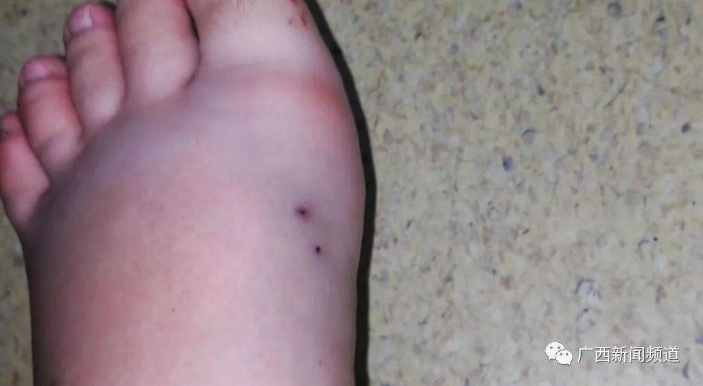 女子旅游遭遇蛇咬事件，应对与反思