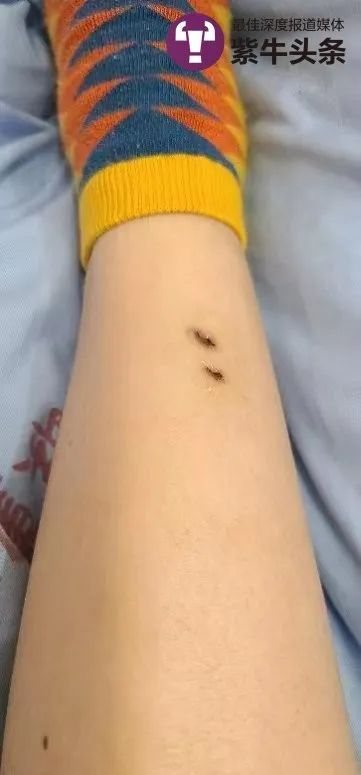 三亚被蛇咬伤致死女子伤口画面曝光，事件深度解析