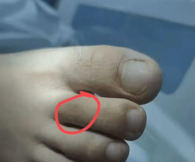 女子疑被蛇咬伤致死事件揭秘，伤口画面曝光