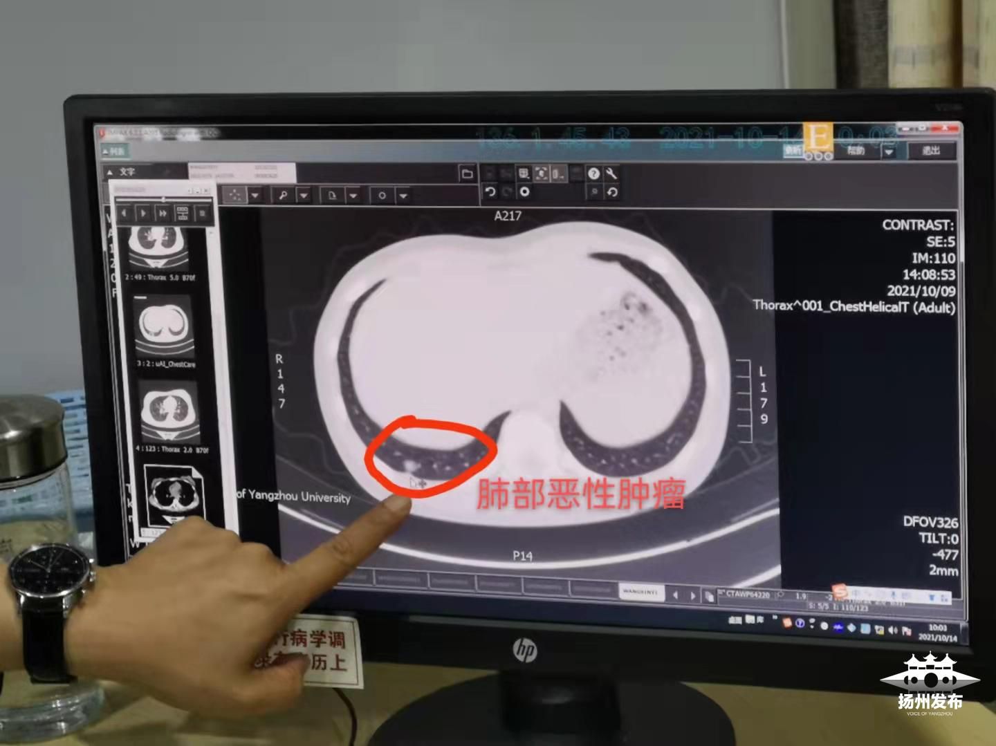 男孩反复发烧咳嗽确诊肺恶性肿瘤，警惕与应对